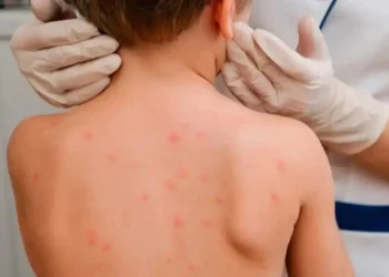 Қазақстанда қызылшаға шалдыққан балалар саны азайып келеді