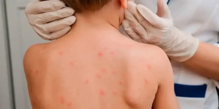 Қазақстанда қызылшаға шалдыққан балалар саны азайып келеді